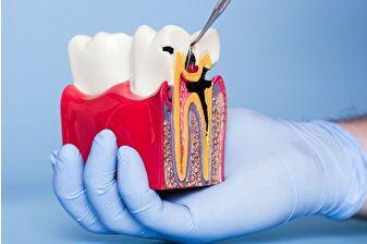 Çürükler ve diş eti hastalıkları felç riskini iki katına çıkarabilir