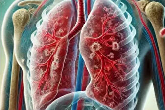 Dünya Sağlık Örgütü: Tüberküloz nedeniyle her yıl bir milyon kişi hayatını kaybediyor
