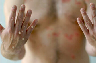 Mpox virüsünde yeni varyantın görülmesi sonrası uzmanlar aşı hatırlatması yaptı