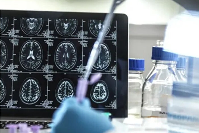 Alzheimer ilacı Donameab’a Avustralya onayı