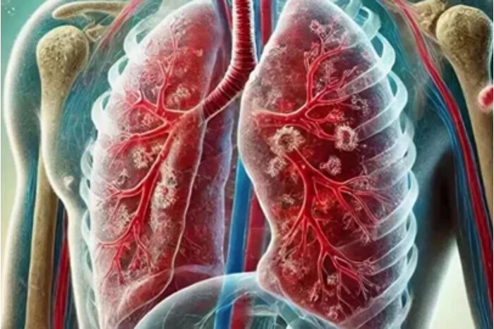 Dünya Sağlık Örgütü: Tüberküloz nedeniyle her yıl bir milyon kişi hayatını kaybediyor