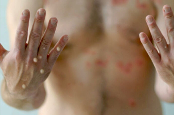 Mpox virüsünde yeni varyantın görülmesi sonrası uzmanlar aşı hatırlatması yaptı