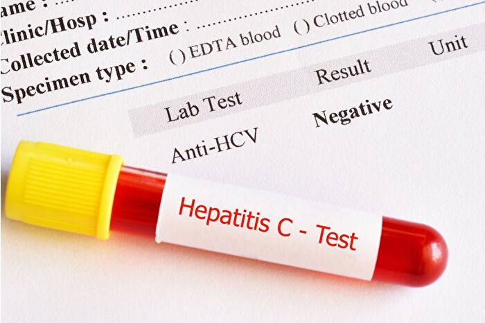 Hepatit C tedavisine aynı gün başlanmasını sağlayacak 15 dakikalık PCR testi geliştirildi
