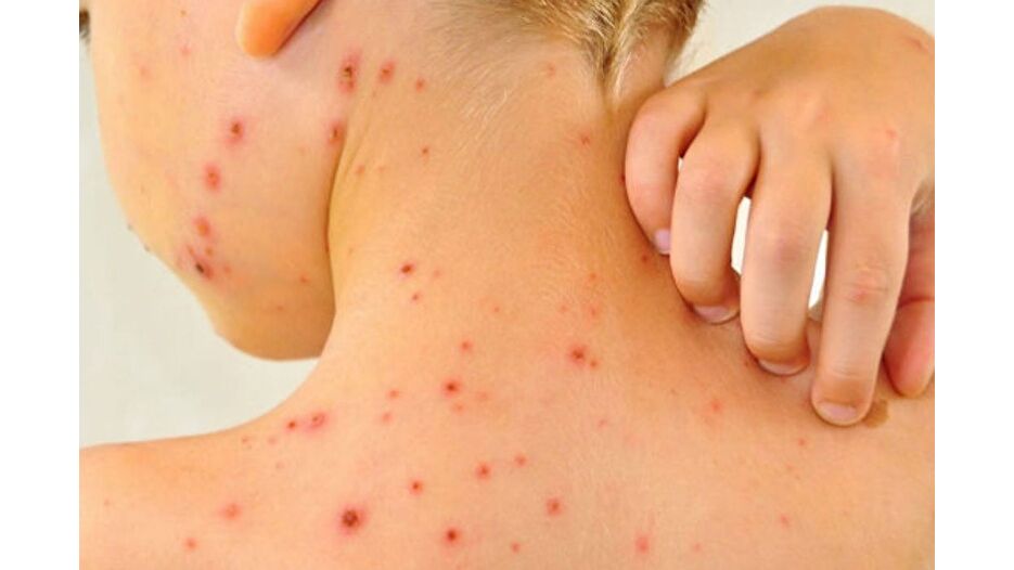 Avrupa ve Orta Asya'da kızamık vakaları artıyor