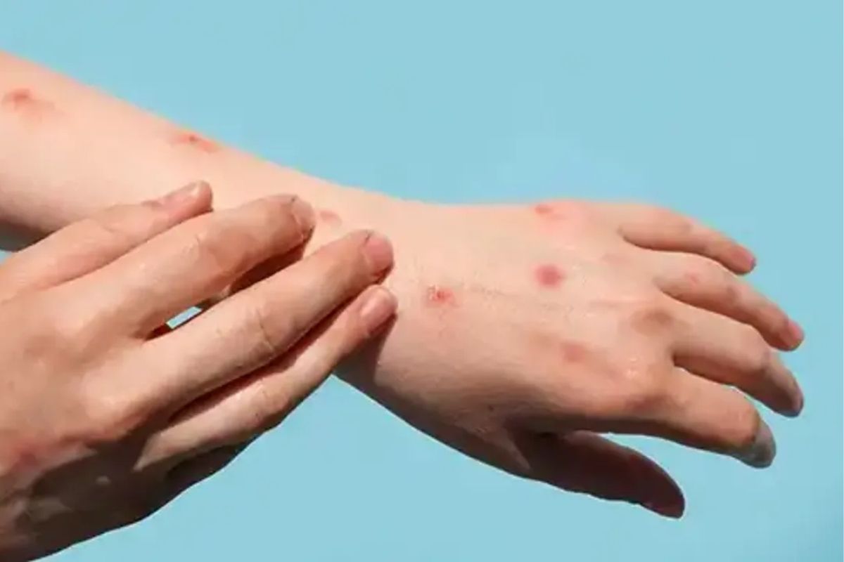 Maymun çiçeği salgını Avrupa'ya sıçradı: İsveç ilk vakayı açıkladı