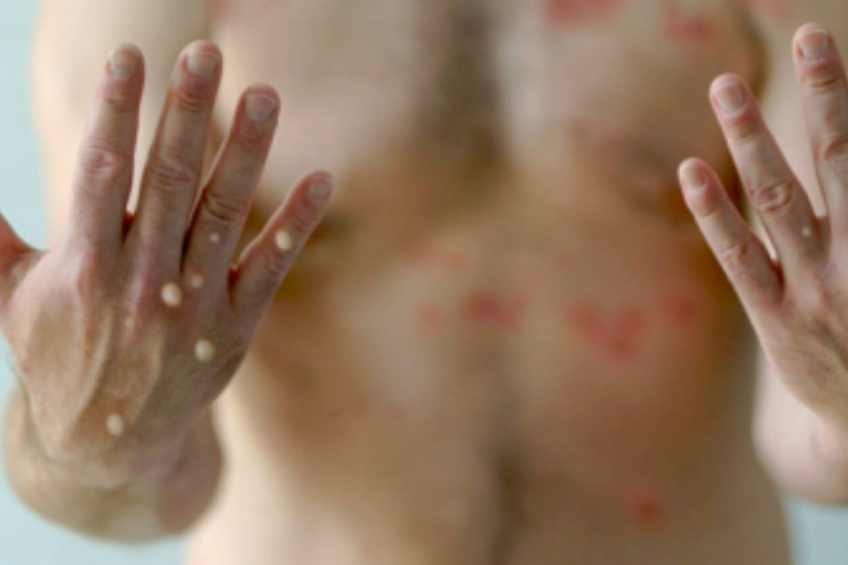 Mpox virüsünde yeni varyantın görülmesi sonrası uzmanlar aşı hatırlatması yaptı