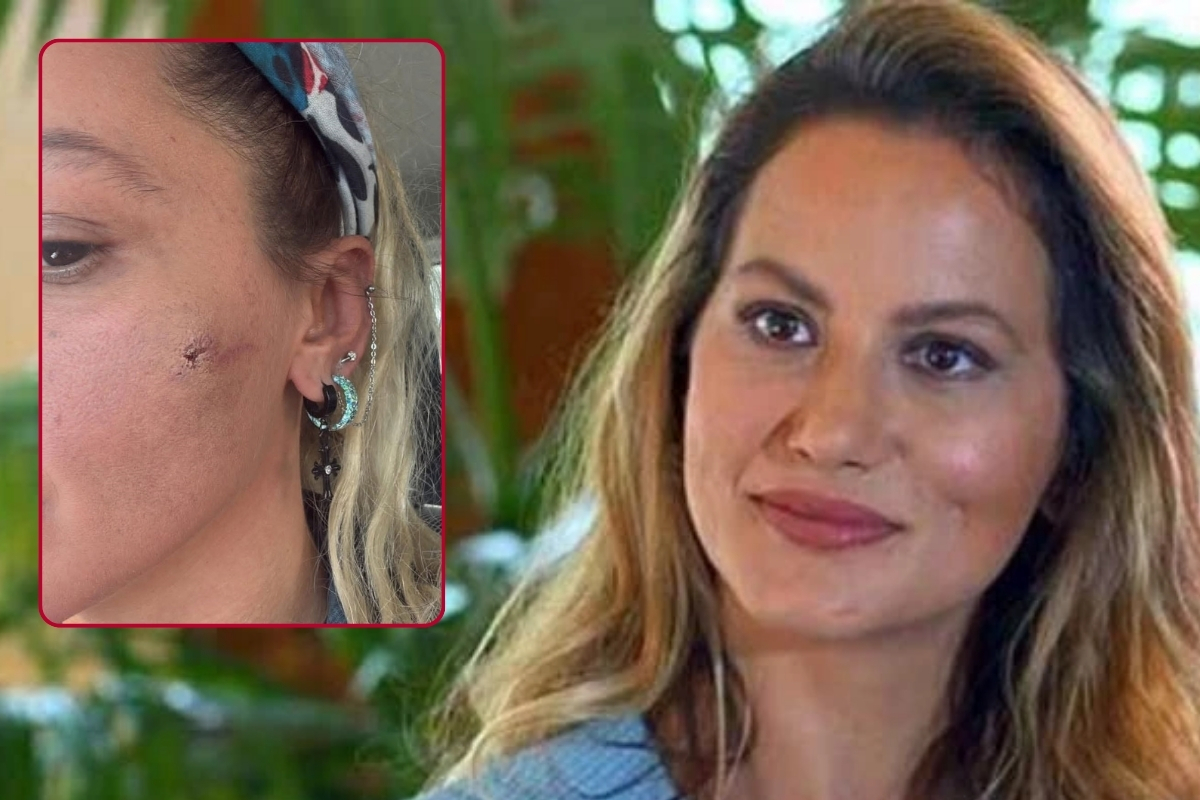 Ünlü oyuncu Yıldız Asyalı yüzündeki morlukları paylaşarak eşinden şiddet gördüğünü duyurdu