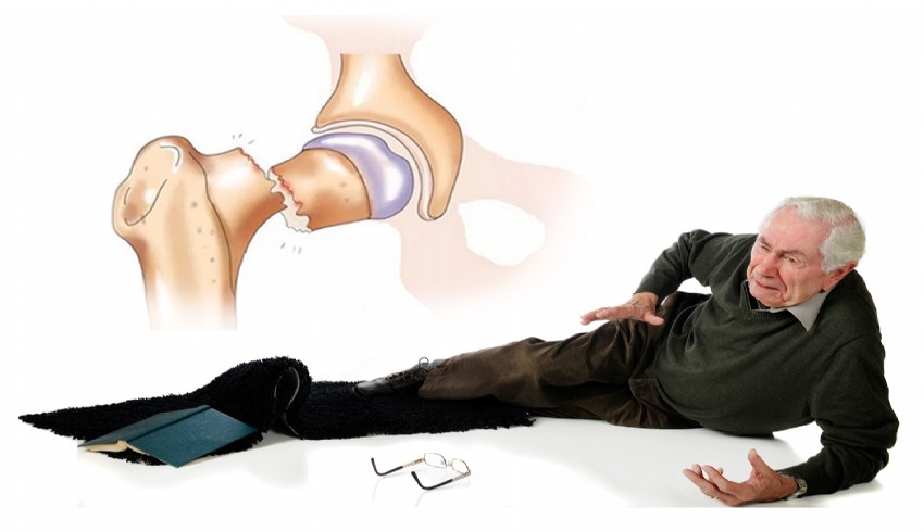 Osteoporoza bağlı kalça kırığı ileri yaş grubundaki hastalar için risk oluşturuyor