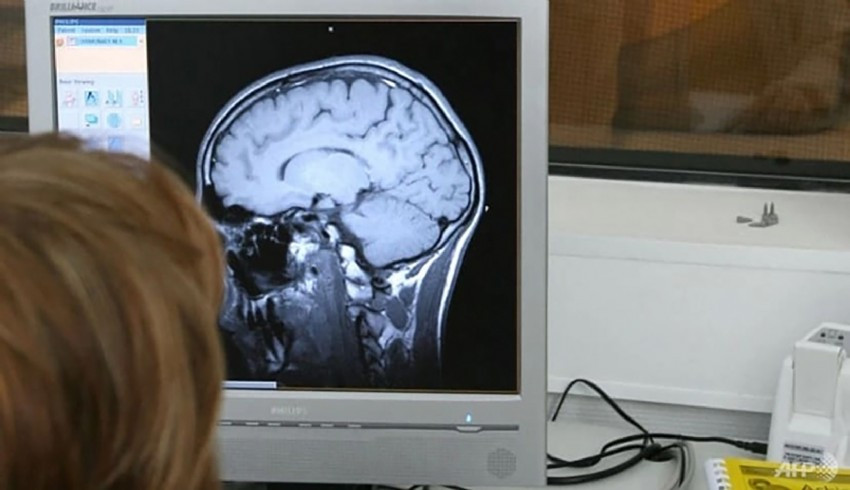 Rusya'da 80 yaşındaki kadının neredeyse hayatı boyunca beyninde iğneyle yaşadığı ortaya çıktı